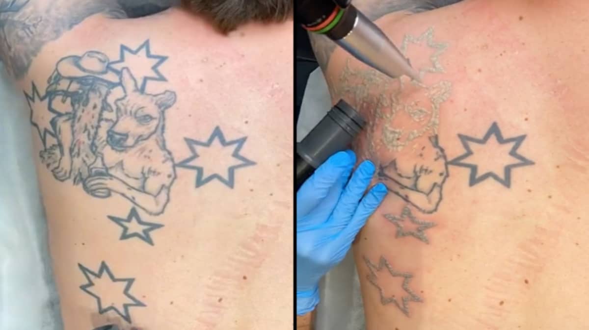Bloke Called 'Un-Australian' For Getting Southern Cross Tattoo Removed