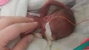 The World’s Most Premature Baby Celebrates First Birthday After 0% Odds Of Survival