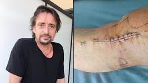 Richard Hammond Shows Off His X-Ray And Scars From 'The Grand Tour' Crash