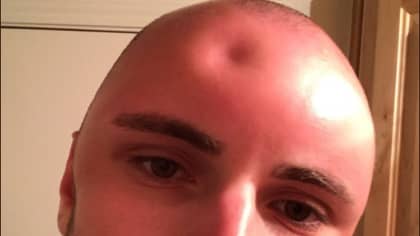 Guy's Head Gets So Sunburned It Swells To Twice Its Size