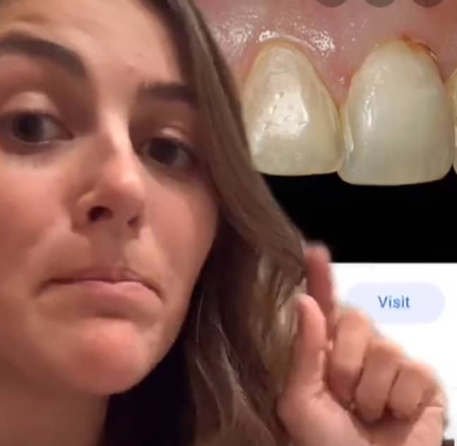 Dr Mawson highlighted that veneers and crowns are very different things. Credit: TikTok/Dr Emi Mawson