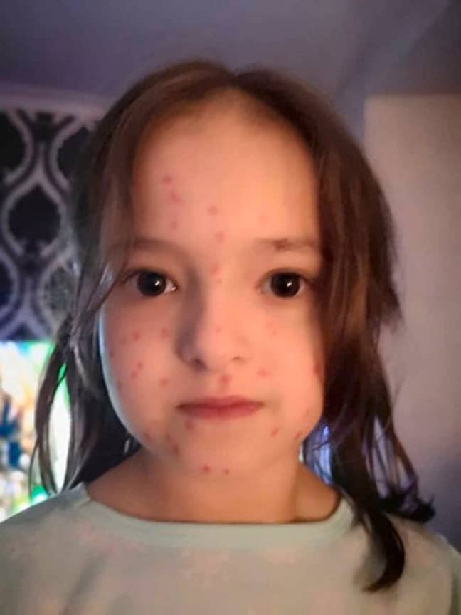 Lily had to go to school with the permanent inking all over her and convince friends that she wasn't contagious. Credit: Kennedy News and Media