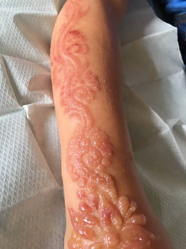 Schoolgirl left With Burns and Scarring After Getting Black Henna Tattoo -  LADbible