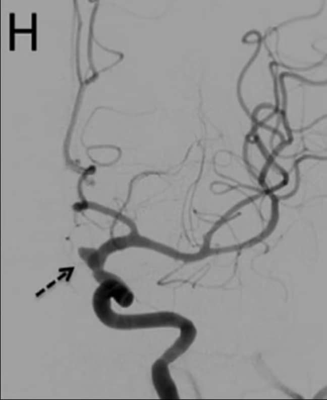 The arrow indicates the patient's aneurysm. Credit: Nagoya City University/Journal of Stroke and Cerebrovascular Diseases