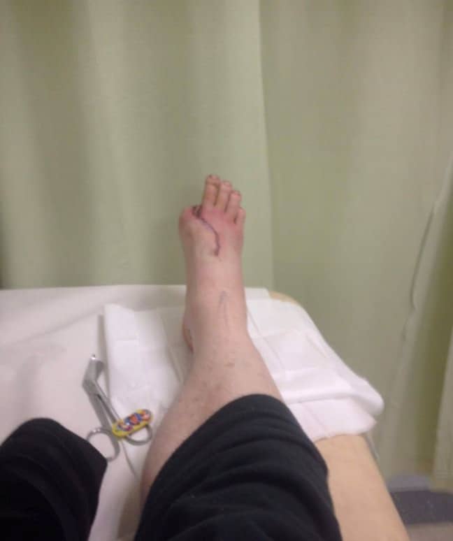 Doctors replaced his thumb with his big toe. Credit: SWNS