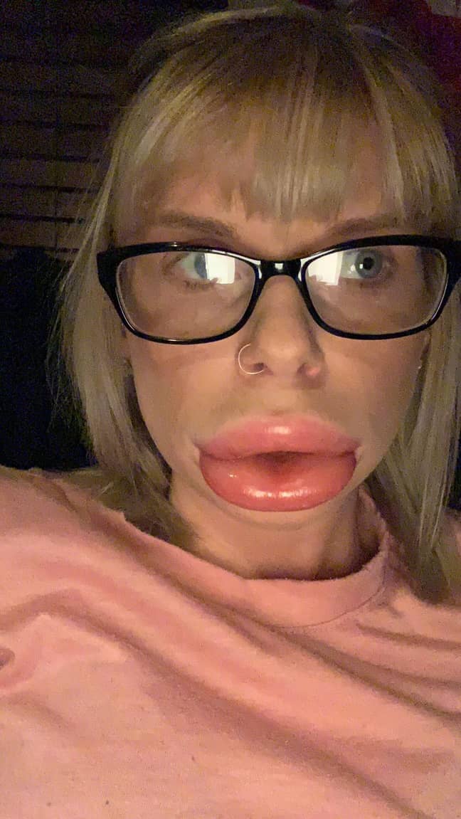 Christina when her lips swelled 'out of control'. Credit: Kennedy News and Media