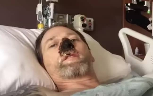 Greg has lost part of his nose to the infection. Credit: CBS