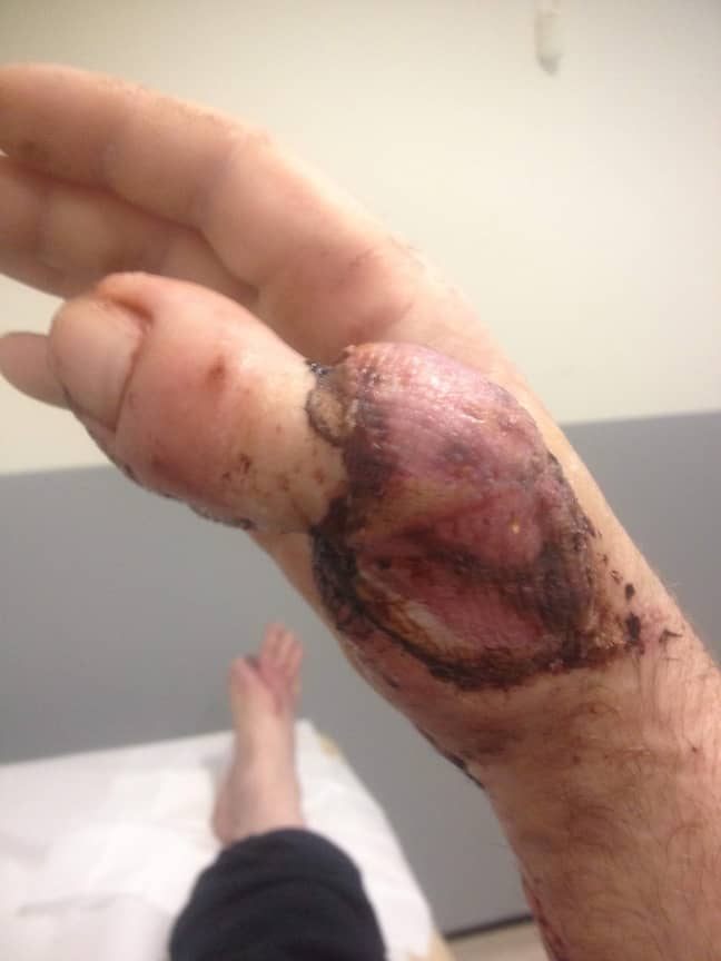 David's thumb was ripped off in an accident at work. Credit: SWNS