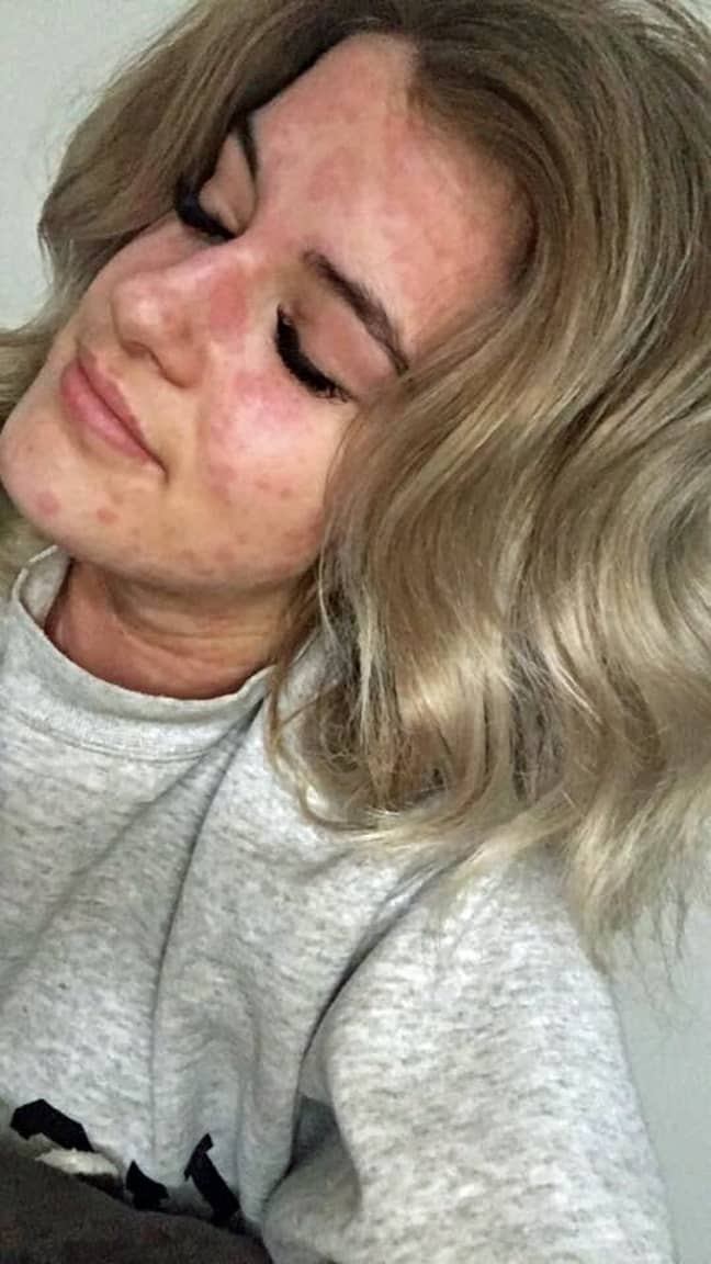 Arianna Kent shows the extent of her allergic reactions. Credit: Caters