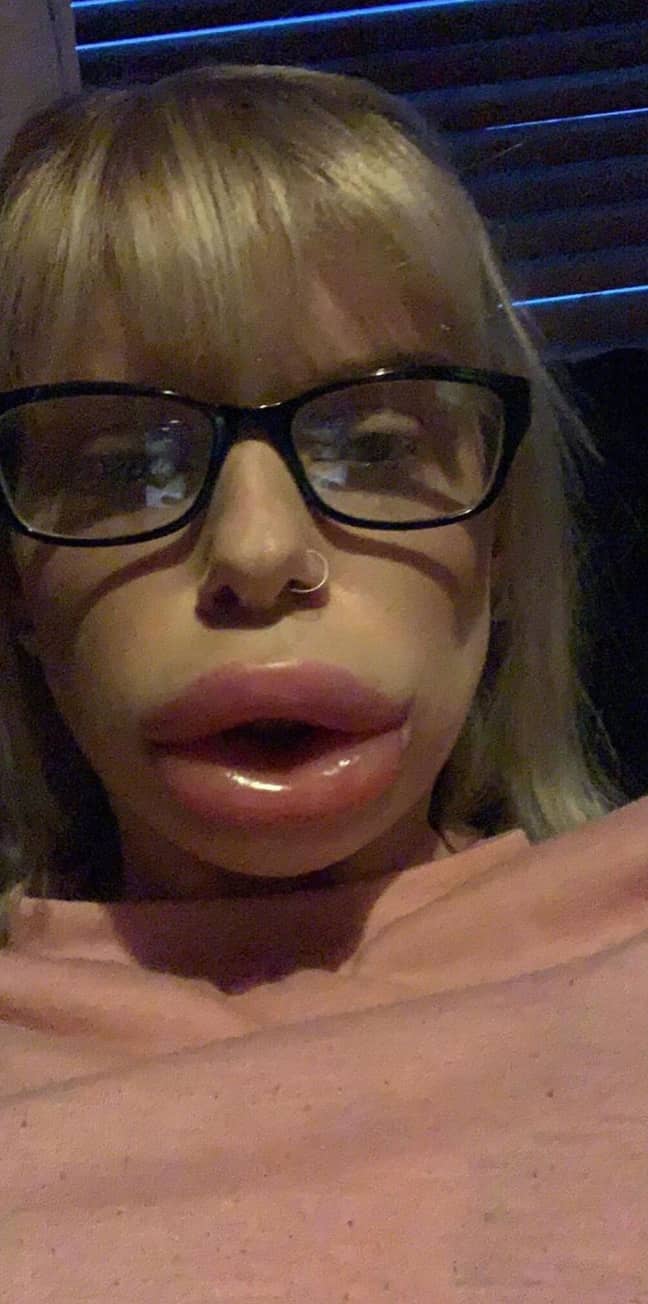Christina's lips just hours after she had fillers. Credit: Kennedy News and Media