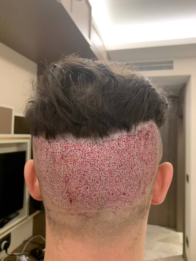 Surgeons, he says, took too much from the back, leaving him with a bald patch. Credit: SWNS