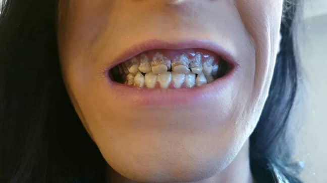Vinnie Pyner's teeth decayed from drinking energy drinks. Credit: SWNS
