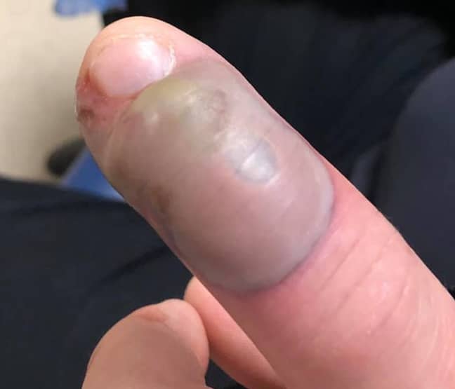 Woman Warns People Not To Bite Nails After Friend Gets Serious Infection -  LADbible