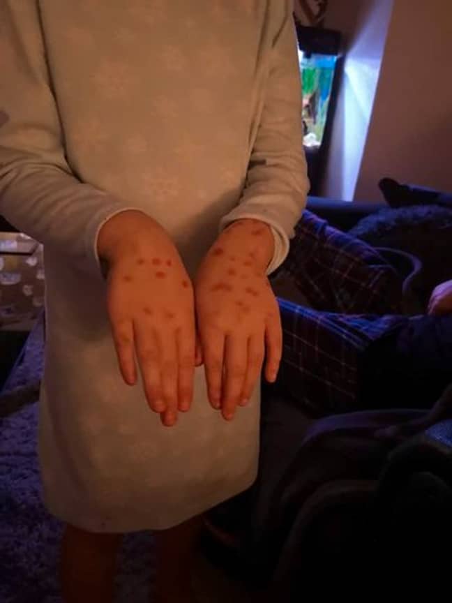 Lily covered in red permanent marker 'chicken pox'. Credit: Kennedy News and Media