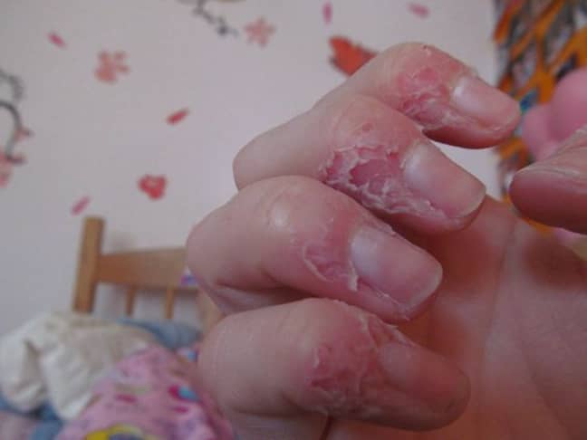 Why You Shouldn't Bite Or Pick The Skin Around Your Finger Nails - LADbible