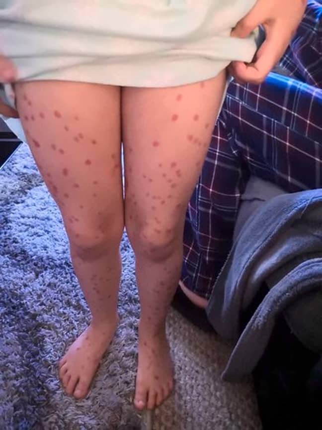 Lily Schooley's makeshift chicken pox. Credit: Kennedy News and Media