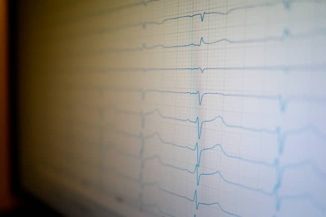 An ECG machine monitoring someone's heart. Credit: PA