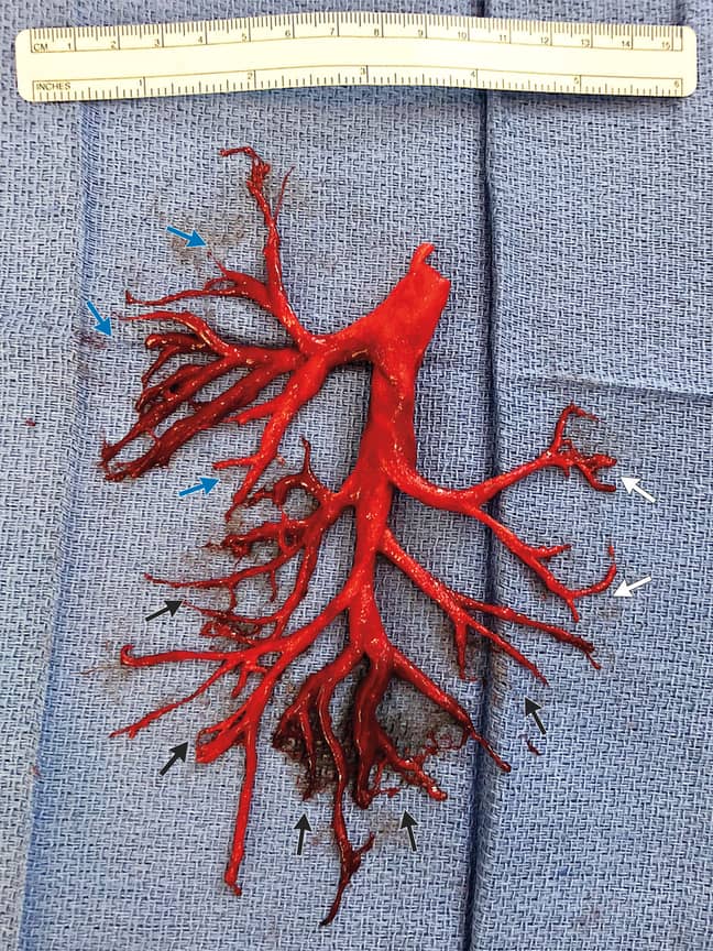 The man coughed up the right bronchial tree. Credit: NEJM