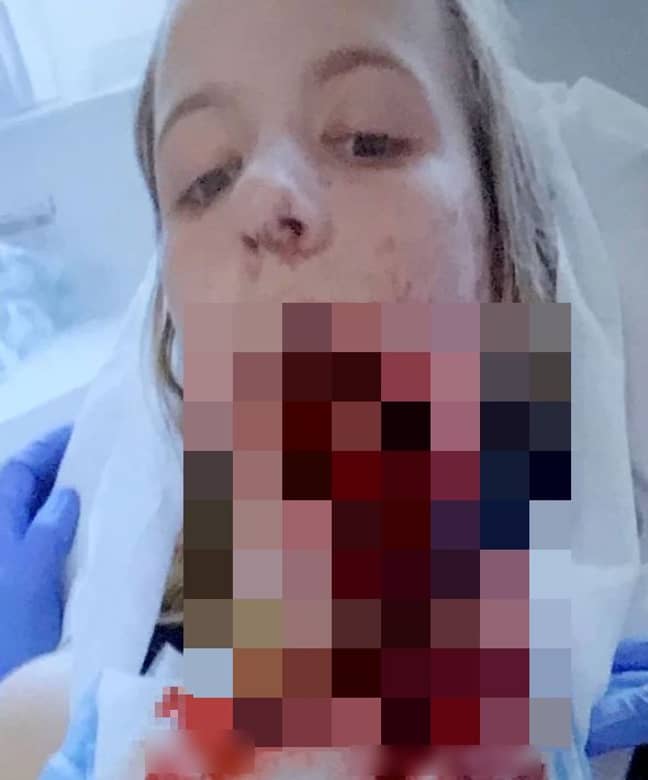 The teenager's jaw split in half after she fell from her horse and smashed her face into a gatepost. Credit: PA