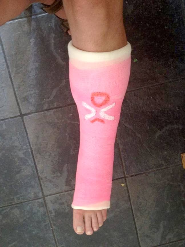 Darren Jones' cast when he damaged his ankle. Credit: Storytrender