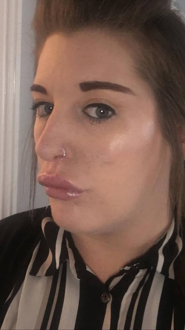 Kelly says she's scared to go out in public after the op left her with 'duck lips'. Credit: Kennedy News
