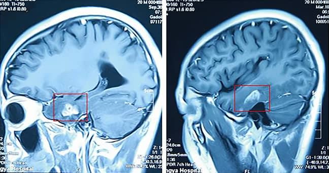 Doctors removed a four-inch-long parasitic tapeworm from this patient's brain. Credit: AsiaWire 