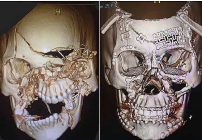 Skull reconstruction
