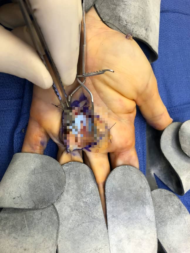 Melissa's hand during surgery. Credit: SWNS