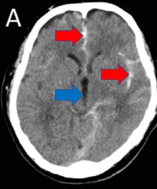 A CT scan showing the stroke the man suffered. Credit: Nagoya City University/Journal of Stroke and Cerebrovascular Diseases