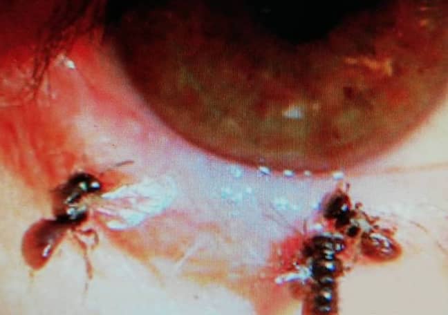 The doctor pulled four bees out of the woman's eye. Credit: AsiaWire