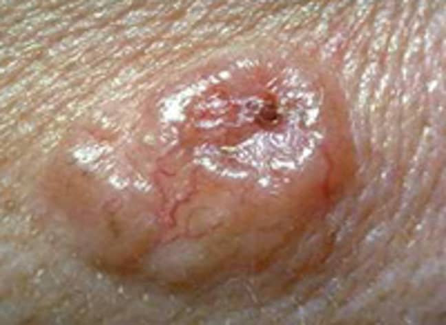 Basal Cell (non-melanoma) skin cancer. (Credit: Cancer Research)