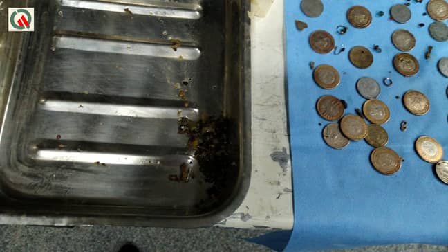 90 coins were removed from the woman's stomach. Credit: SWNS
