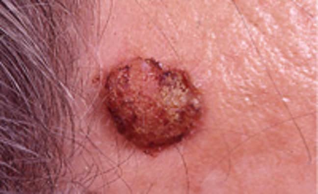 Melanoma skin cancer. (Credit: Cancer Research)