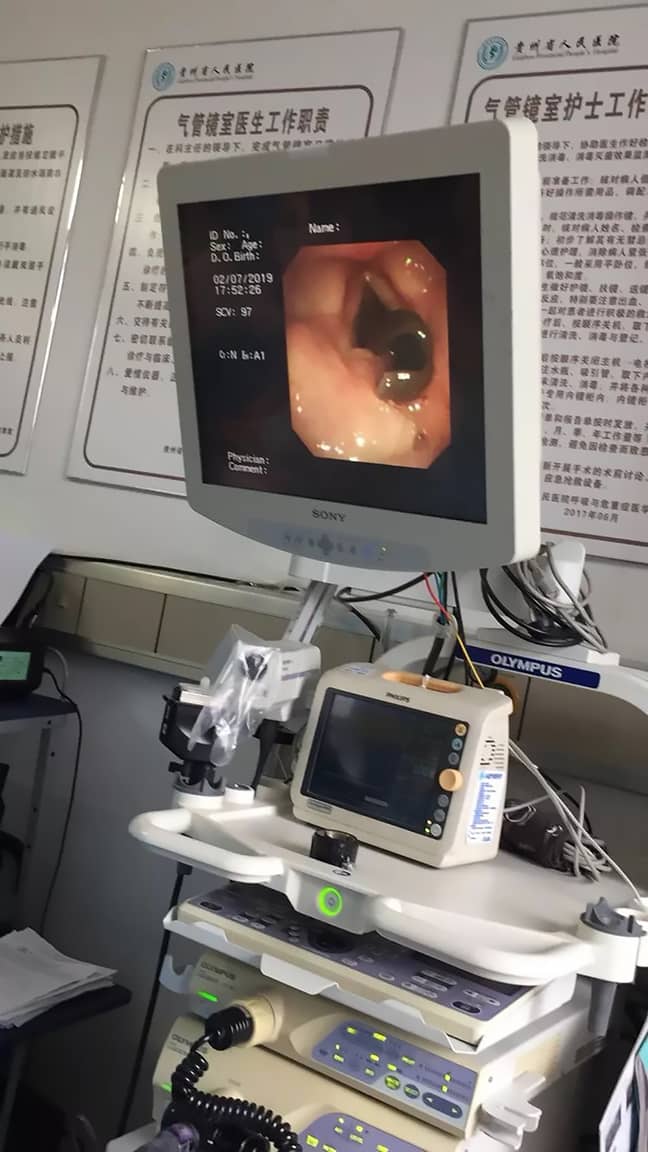 Doctors froze the parasite with dry ice before removing it. Credit: AsiaWire