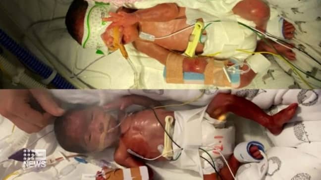 Newborn twins in intensive care at the hospital.