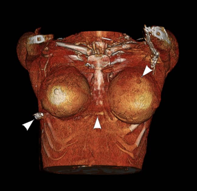 The bullet entry point was above the left nipple. Credit: Plastic Surgery Case Studies/McEvenue