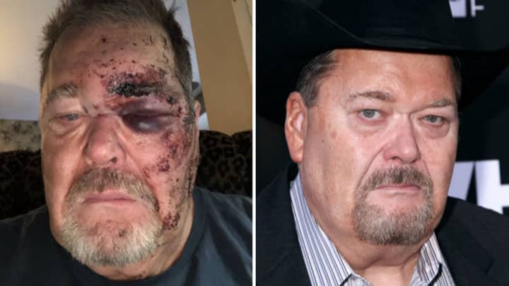 WWE's Jim Ross Literally Broke His Face Last Night 