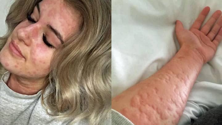 Meet The 21-Year-Old Woman Who’s Allergic To Winter