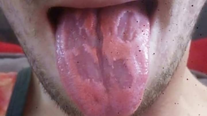 Teacher Shares Photo Of Tongue 'Eaten Away' By Energy Drinks
