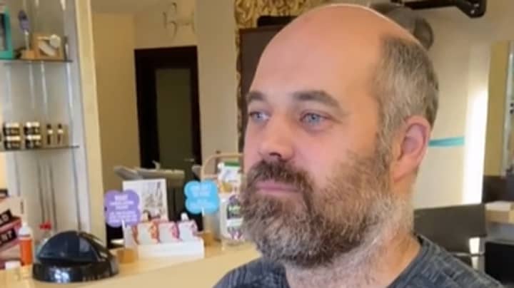 Balding Man Looks Decade Younger Thanks To New Hair System