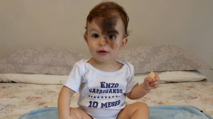 Mum Gets Replica Of Son's Facial Birthmark So She Can See What Life Is Like For Him