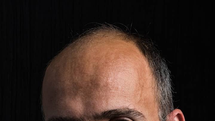 New Stem Cell Solution Triggers Hair Regrowth In People With Male Pattern Baldness 