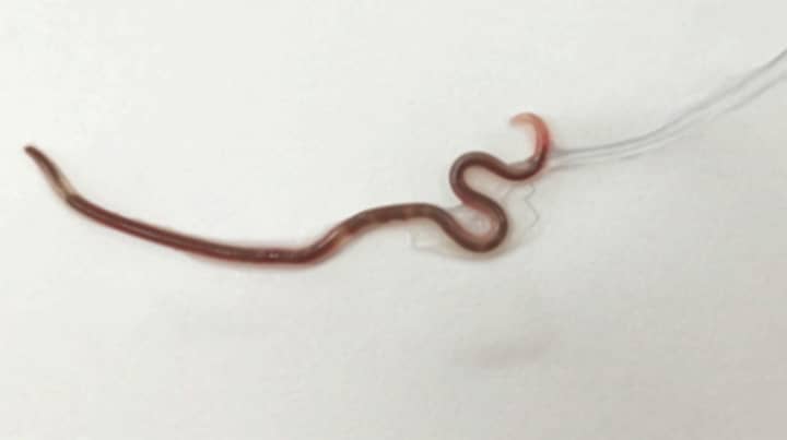 Doctors Find 3.8 Centimetre Worm In Woman's Mouth After She Ate Sashimi