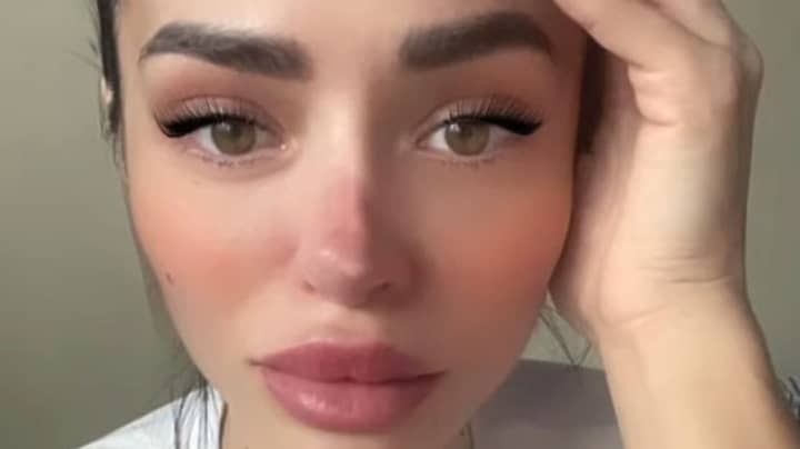 Influencer Says Her Nose Is Rotting Away After Botched Surgery 