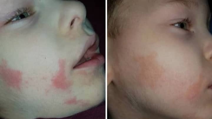 £4.50 Miracle Cream Helps Cure Boy's Eczema In Just Four Days