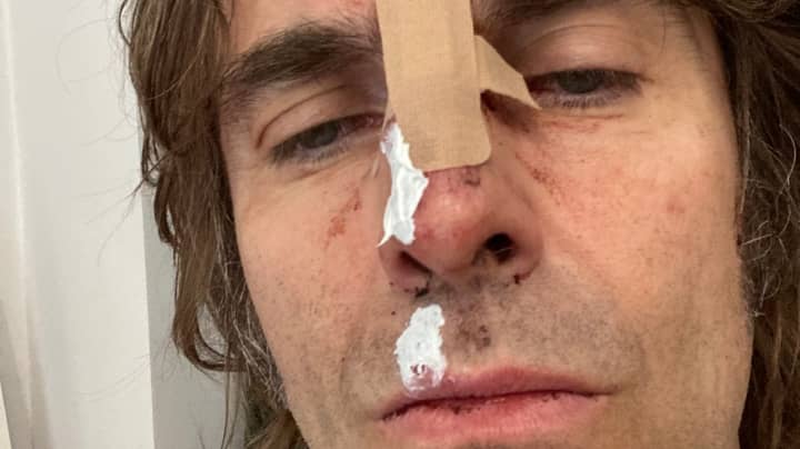 Liam Gallagher Reveals Injuries After Falling Out Of A Helicopter