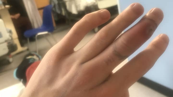 Pet Shop Worker Bitten By False Widow Left With Sausage-Sized Finger