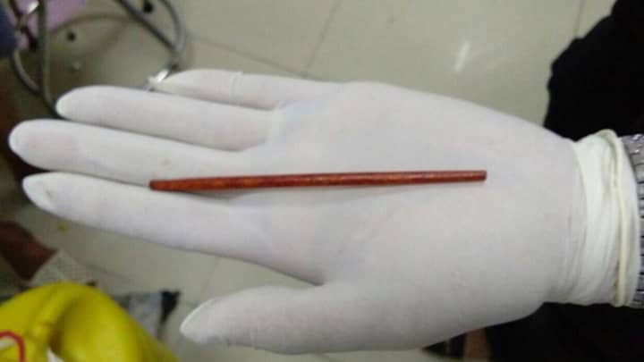 A Guy Had To Get A Chopstick Removed From His Penis After Inserting It While Blind Drunk