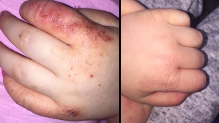 Mum Claims £3.99 'Miracle' Cream Cured Her Little Girl's Eczema