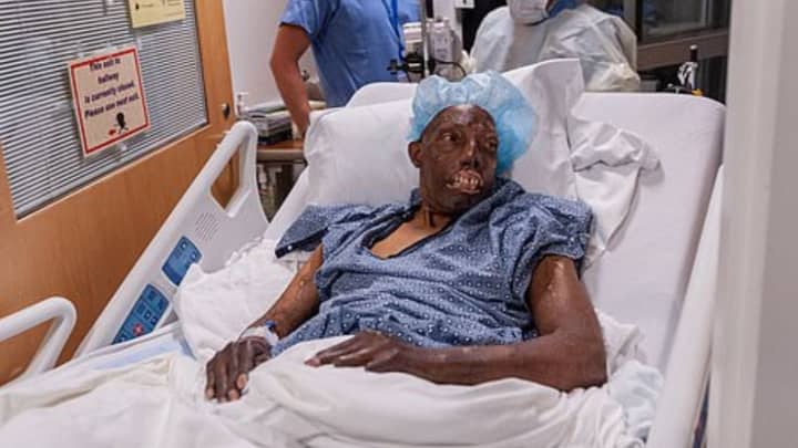 Man, 68, Becomes First Black Person To Have A Full Face Transplant 